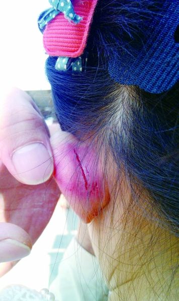 　　女童的耳朵被老師揪裂。圖片由女童家人提供