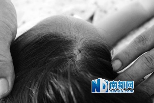 女童頭上被扎的針孔（圓圈處）。賈先生說，被扎不到三秒鐘，女兒就昏了。