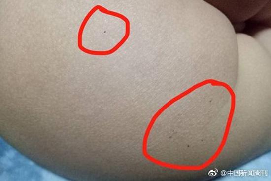 據(jù)多名紅黃藍(新天地分園)家長反映，孩子腿部、屁股、腋下出現(xiàn)針眼。