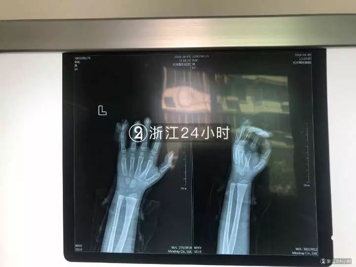 嚇哭！6歲男孩被夾斷手指 罪魁禍?zhǔn)拙故切７? oldsrc=